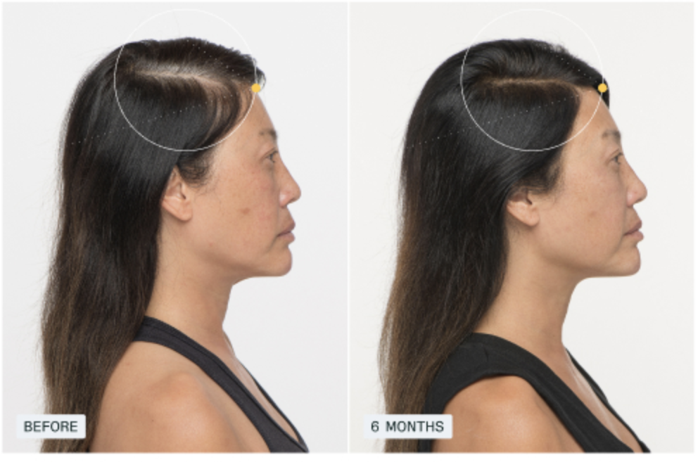 Hair appearance comparison image supplied with Nutrafol product materials